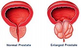 Astellas and Friends of Cancer Patients join forces to raise awareness of prostate cancer